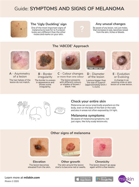 dermnet melanoma|pictures of melanoma early stage.